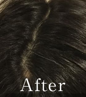 40代女性 発毛施術アフター