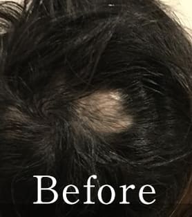 40代女性 発毛施術ビフォー