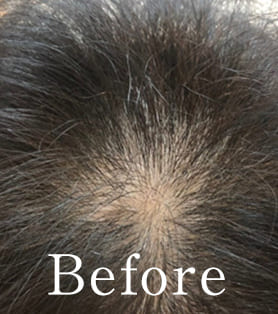 60代女性 発毛施術ビフォー